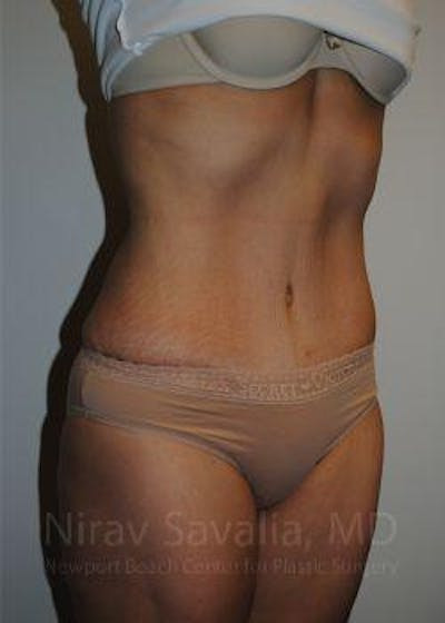 Breast Augmentation Before & After Gallery - Patient 1655601 - After