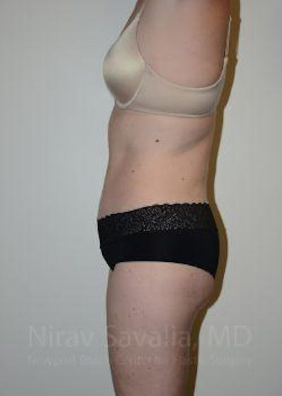 Body Contouring after Weight Loss Before & After Gallery - Patient 1655603 - After