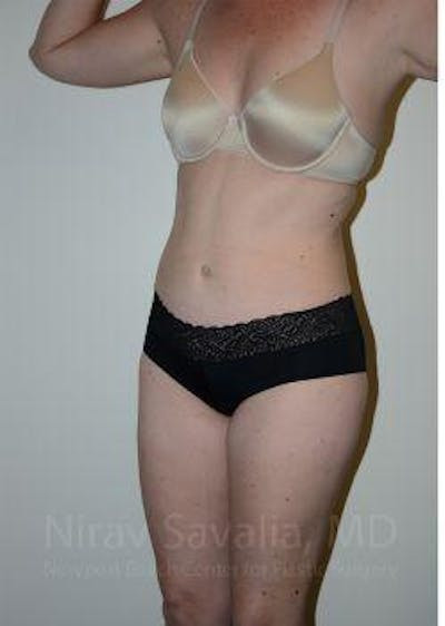 Body Contouring after Weight Loss Before & After Gallery - Patient 1655603 - After