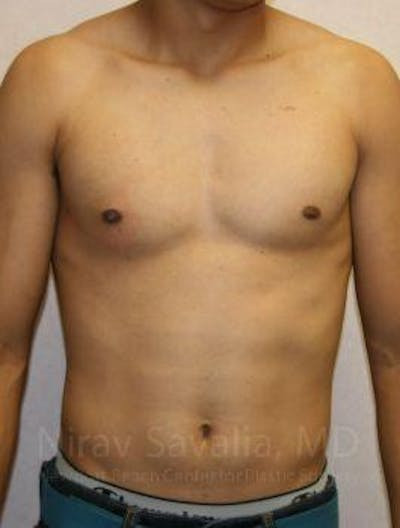 Abdominoplasty Tummy Tuck Before & After Gallery - Patient 1655607