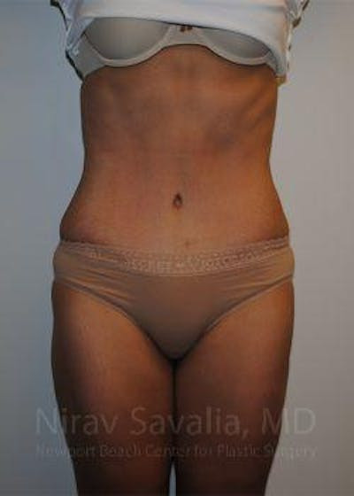 Abdominoplasty Tummy Tuck Before & After Gallery - Patient 1655608