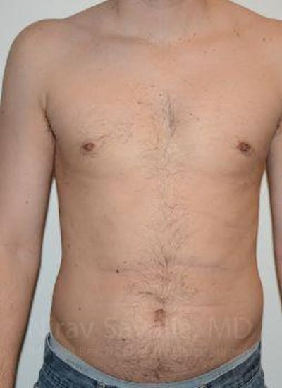Mastectomy Reconstruction Before & After Gallery - Patient 1655612