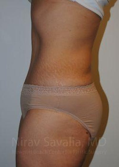 Abdominoplasty Tummy Tuck Before & After Gallery - Patient 1655611 - After