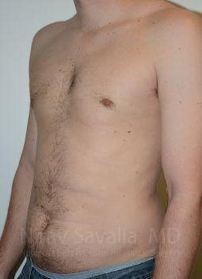 Liposuction Before & After Gallery - Patient 1655612 - After