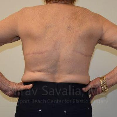 Oncoplastic Reconstruction Before & After Gallery - Patient 1655616