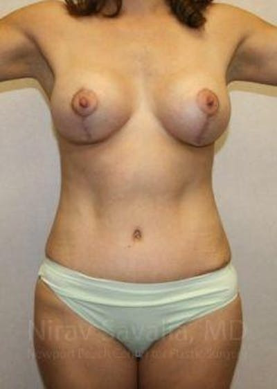 Abdominoplasty Tummy Tuck Before & After Gallery - Patient 1655621