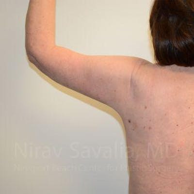 Breast Lift with Implants Before & After Gallery - Patient 1655643 - After
