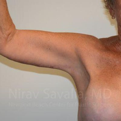 Mastectomy Reconstruction Before & After Gallery - Patient 1655646