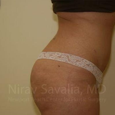 Breast Reduction Before & After Gallery - Patient 1655647 - After