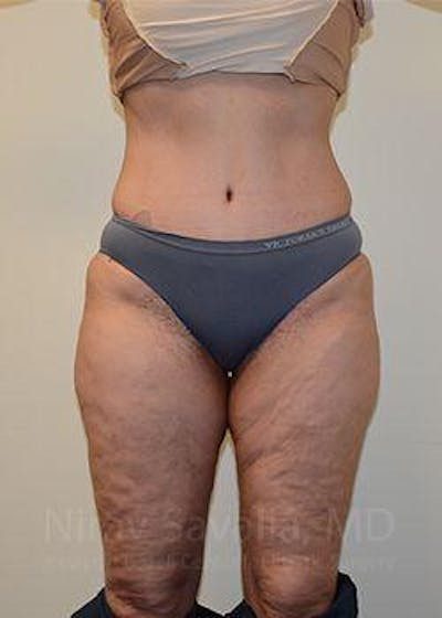 Abdominoplasty Tummy Tuck Before & After Gallery - Patient 1655654