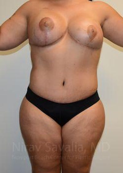 Mastectomy Reconstruction Before & After Gallery - Patient 1655657