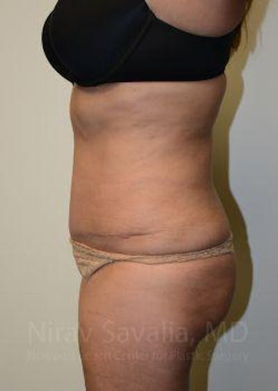 Breast Lift with Implants Before & After Gallery - Patient 1655659 - After