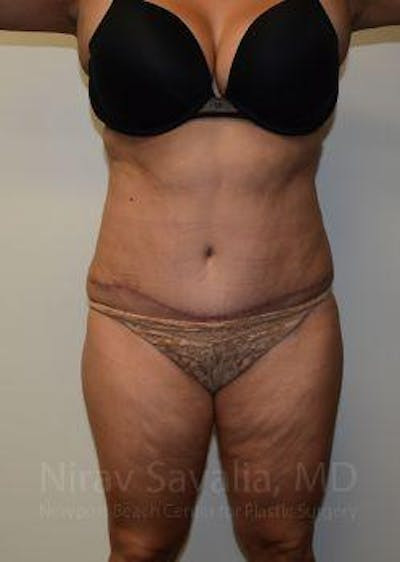Mastectomy Reconstruction Before & After Gallery - Patient 1655664