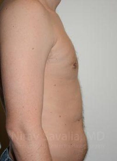 Breast Explantation En Bloc Capsulectomy Before & After Gallery - Patient 1655667 - After