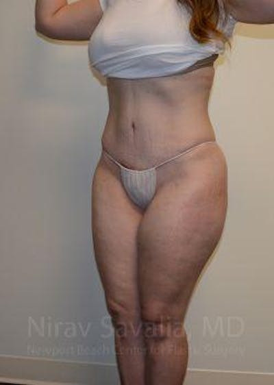 Body Contouring after Weight Loss Before & After Gallery - Patient 1655670 - After