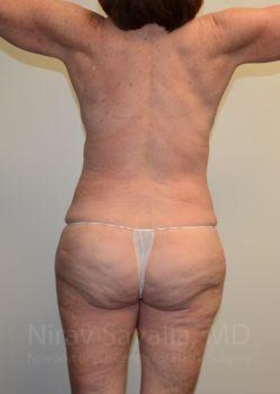 Oncoplastic Reconstruction Before & After Gallery - Patient 1655673 - After