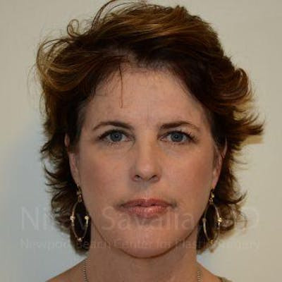 Oncoplastic Reconstruction Before & After Gallery - Patient 1655688