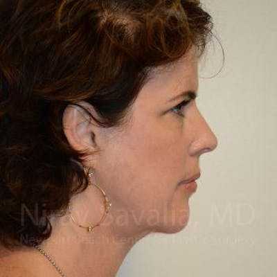 Facelift Before & After Gallery - Patient 1655689 - After