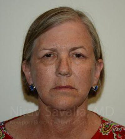 Mommy Makeover Before & After Gallery - Patient 1655699 - After