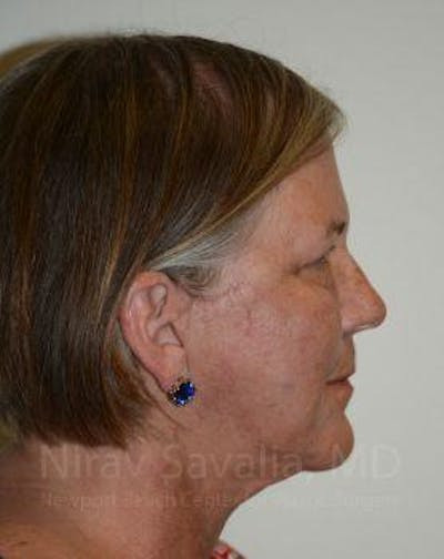Oncoplastic Reconstruction Before & After Gallery - Patient 1655699