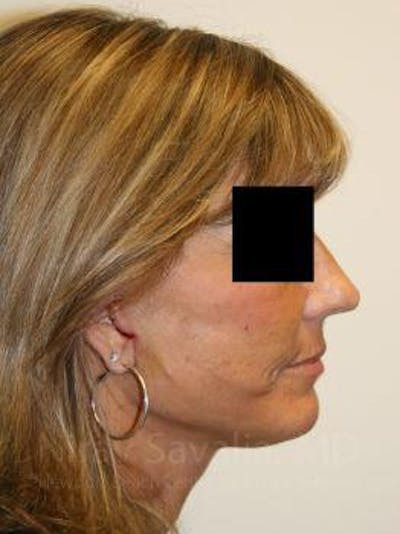 Mommy Makeover Before & After Gallery - Patient 1655704 - After