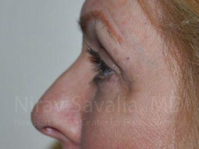 Torn Earlobe Repair Ear Gauge Repair Before & After Gallery - Patient 1655707 - After