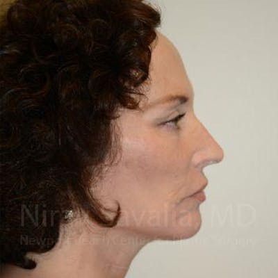 Oncoplastic Reconstruction Before & After Gallery - Patient 1655712