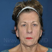  Before & After Gallery - Patient 1655716 - Image 1