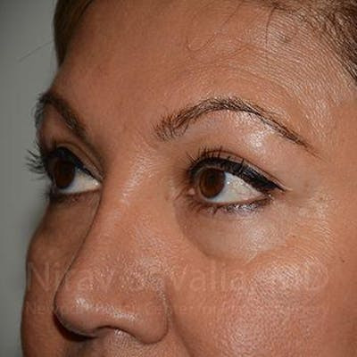 Mommy Makeover Before & After Gallery - Patient 1655728 - After