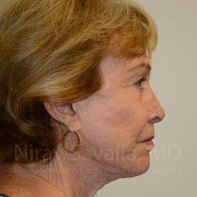 Oncoplastic Reconstruction Before & After Gallery - Patient 1655786