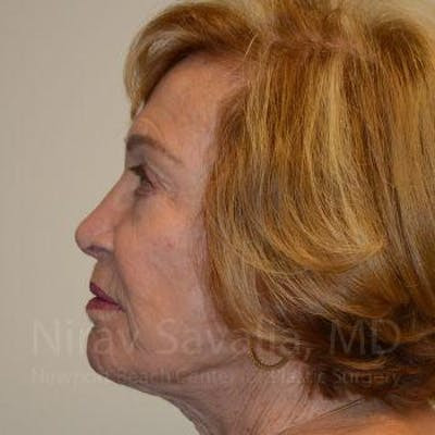 Mommy Makeover Before & After Gallery - Patient 1655786 - After