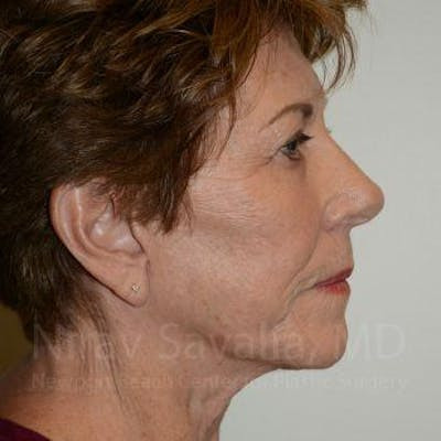 Oncoplastic Reconstruction Before & After Gallery - Patient 1655791
